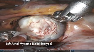 Robotic Heart Surgery Techniques (VIII) - Left Atrial Myxoma Excision, Solid Subtype