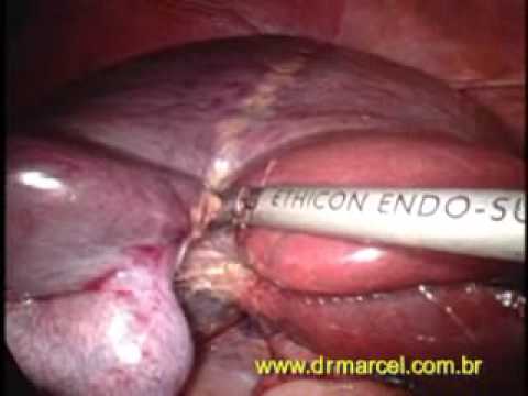 Liver Resection Liver Resection