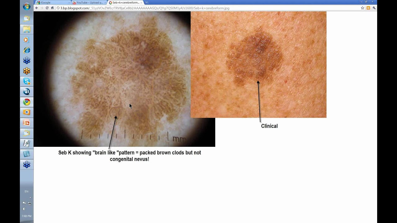 seborrheic keratosis vs melanoma
