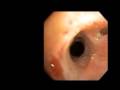 Wegeners Granulomatosis History | RM. Wegeners Granulomatosis History | RM.