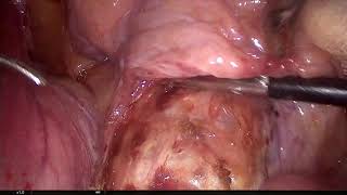 Pectopexy For Uro Genital Prolaps-Dr Laila Chouhou-Morocco