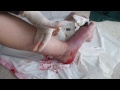 Amputation