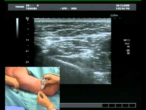 Radial Nerve Block (ultrsound guided) - YouTube