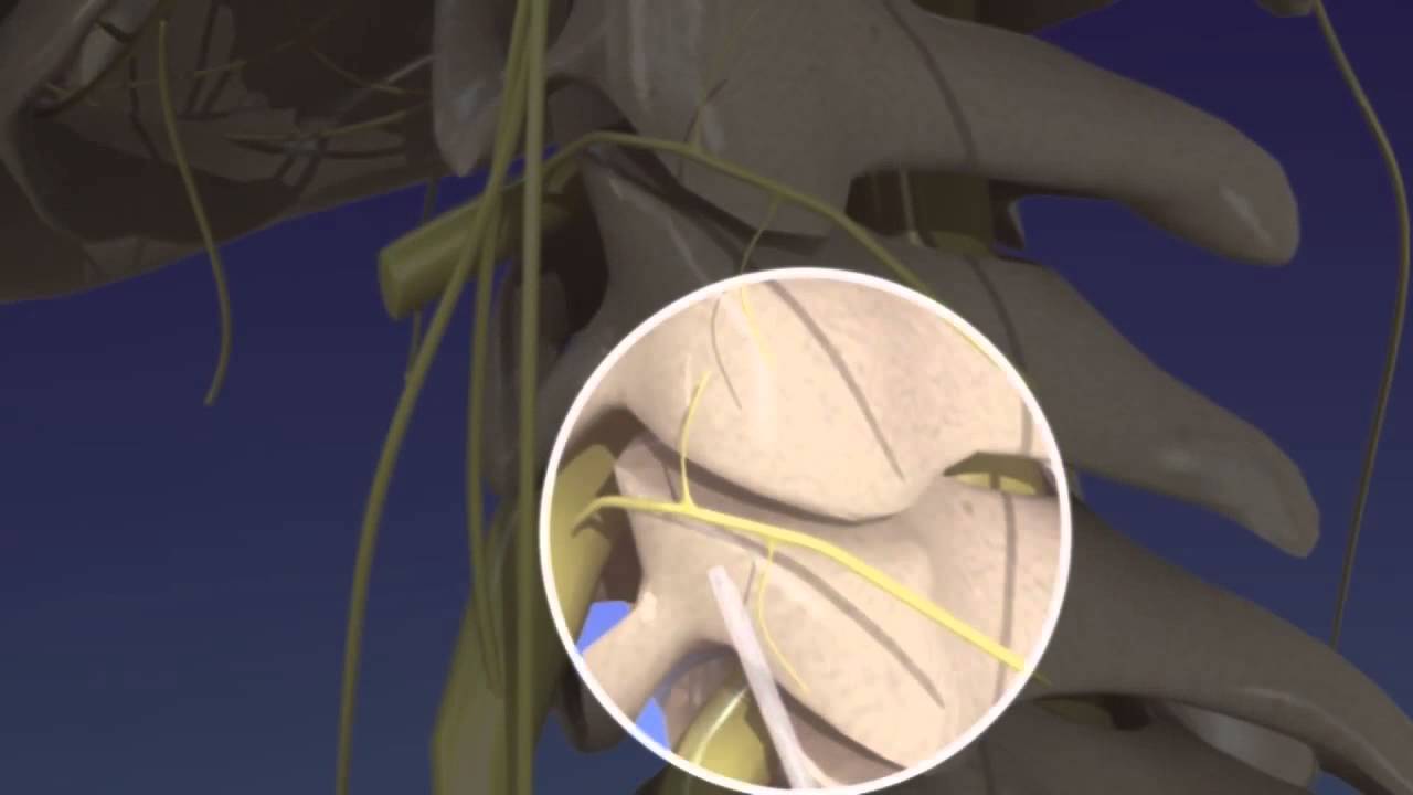 Cervical Facet Radiofrequency Neurotomy - Neck - YouTube