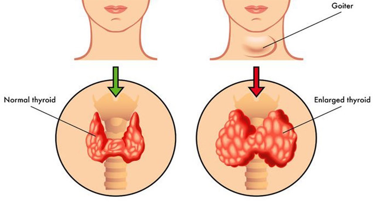 Лишний Вес И Заболевание Щитовидной Железы