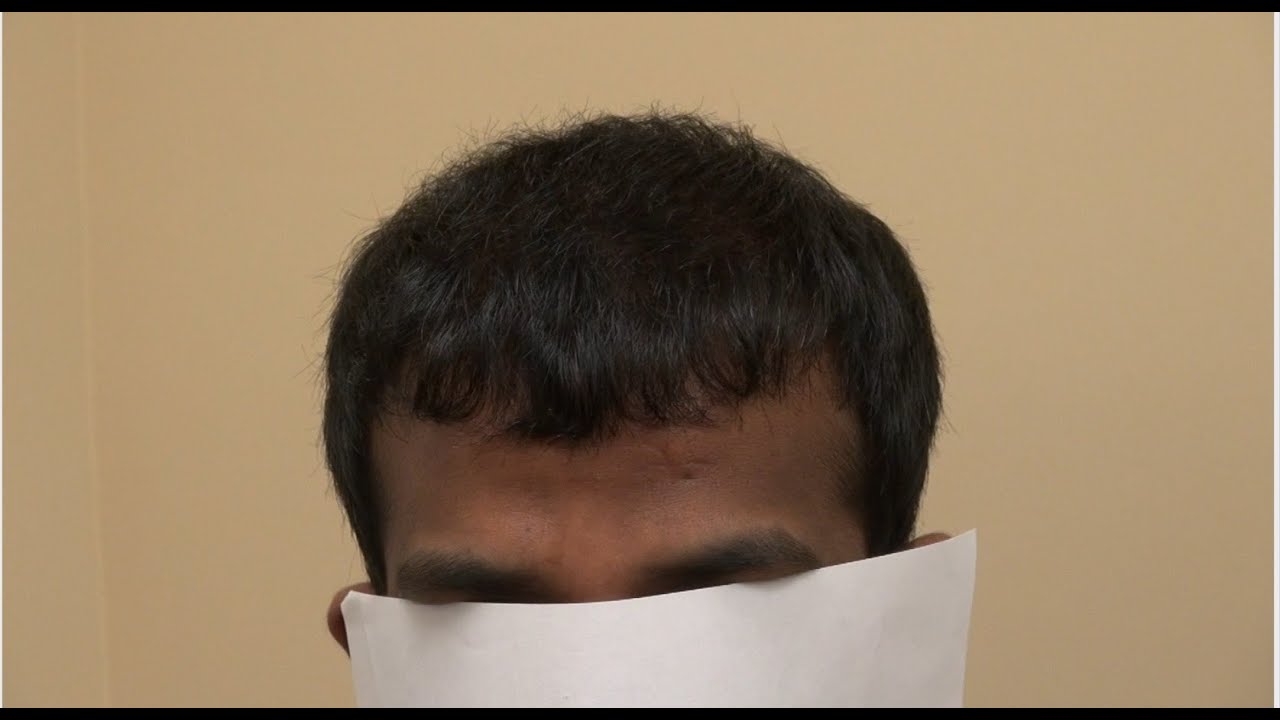 5000 grafts hair transplant photos 5000 grafts hair transplant photos