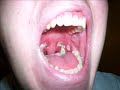cauterized tonsils