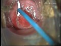 LEEP CIN 2 HPV