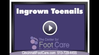 Ingrown Toenails Podiatrist Cincinnati West Chester Ohio Dr Kristin Ko Center For Foot Care