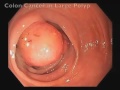 Colonoscopy Video Tour: Discovery of a Cancerous Polyp (Colon Cancer)