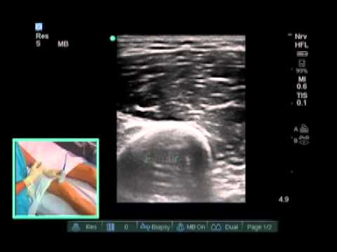 Ultrasound-Guided Saphenous Nerve Block - SonoSite.mp4 - YouTube