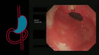 Refractory Coeliac Disease, Ulcerative Jejunitis Duodenitis & Lymphocytic Gastritis