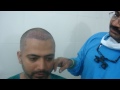 hair transplantation in India