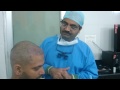 hair transplantation in India