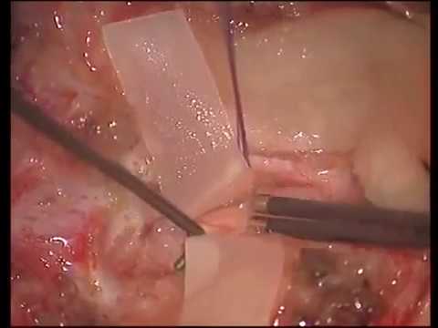 Major Steps of a Tethered Spinal Cord Syndrome surgery Major Steps of a Tethered Spinal Cord Syndrome surgery