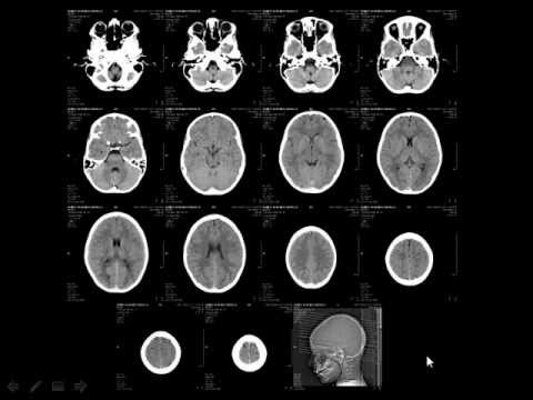 Radiology - Normal brain anatomy - CT and MRI - YouTube