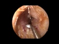 Ear Wax (Cerumen) Removal in HD