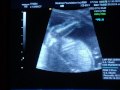 19 weeks and 6 days Ultrasound Part 1