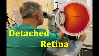 Retinal Detachment Tear, Peripheral Photocoagulation 4K