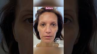 Sculptra Results