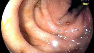 Melanosis Coli-Part Ii