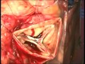 How To Perform an Aortic Root Replacement: Arie Blitz, MD