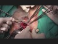 Prolapse Repair with Surelift mesh - Surgical intervention