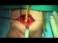 Dr. Banno: LGX Inflatable Penile Implant