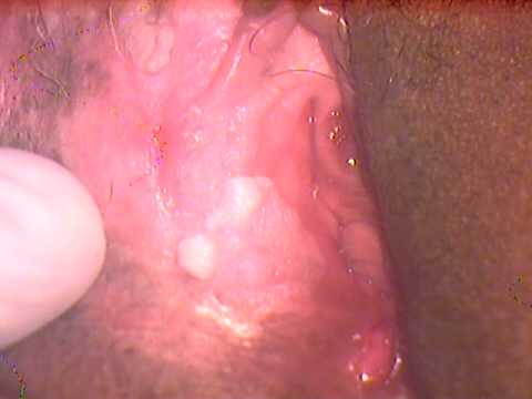 CANCER VULVA cancer vulva: