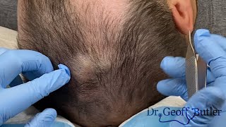 Removal Of A Pilar Cyst
