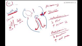Atrioventricular re-entrant tachycardia - Dr Jamal - ECG Lectures