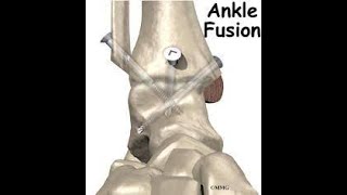Tibiotalar Arthrodesis Lateral Ankle Arthodosis Ankle Arthrodesis Ankle Fusion