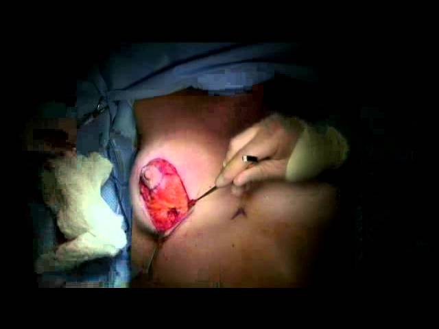 Benelli Breast Lift Revision-Dr Kevin Brenner for Surgery Theater.mp4