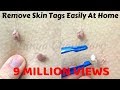 Top 5 Home Remedies To Remove Skin Tags | How To Remove Skin ...