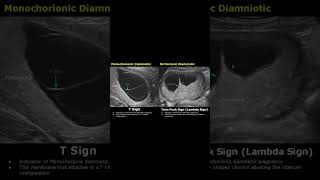 T-Sign & Twin Peak Sign Lambda Sign Fetal Ultrasound Scan Pregnancy Usg