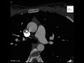 Right Coronary Artery Aneurysm on Cardiac CT (Gated)