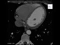 Right Coronary Artery Aneurysm on Cardiac CT (Gated)