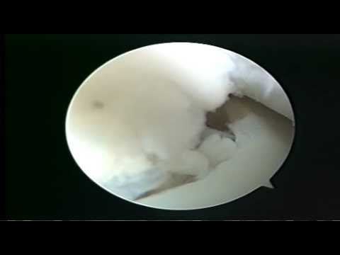 www.ankle-arthroscopy.co.uk