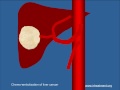 ChemoEmbolization (TACE) for Liver Cancer