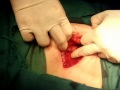 hernioplastia