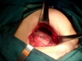 hernioplastia