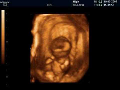 Dancing Baby Animation. 3D scan of our dancing baby