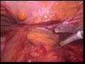 Laparoscopy for diverticulitis with abscess and fistula - Conor Delaney