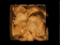3D fetal ultrasound - amazing things fetuses do in the womb - Dr. I. Shapiro