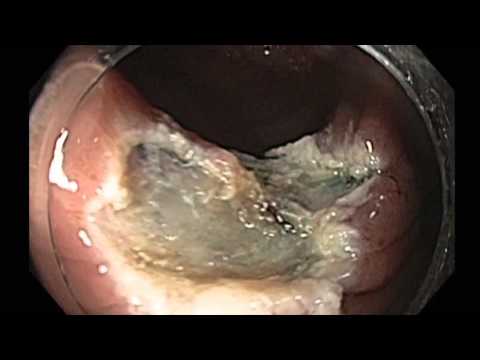 severe constipation after colonoscopy severe constipation after colonoscopy