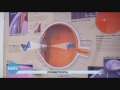 Ipermetropia pediatrica Ipermetropia pediatrica