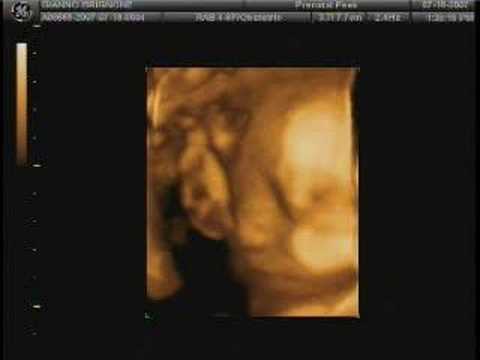 3d ultrasound 20 weeks pregnant. 3D Ultrasound 31 weeks (Gianno