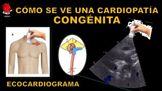 Persistencia Del Conducto Arterioso Ecocardiograma