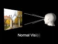 Video 1. Visual aura of migraine