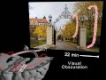 Video 1.  Visual aura of migraine